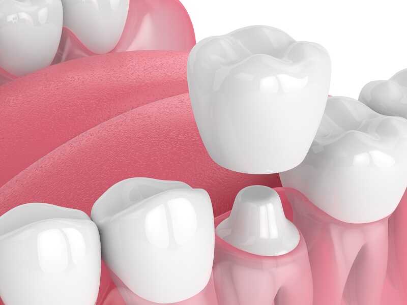 Coroane dentare